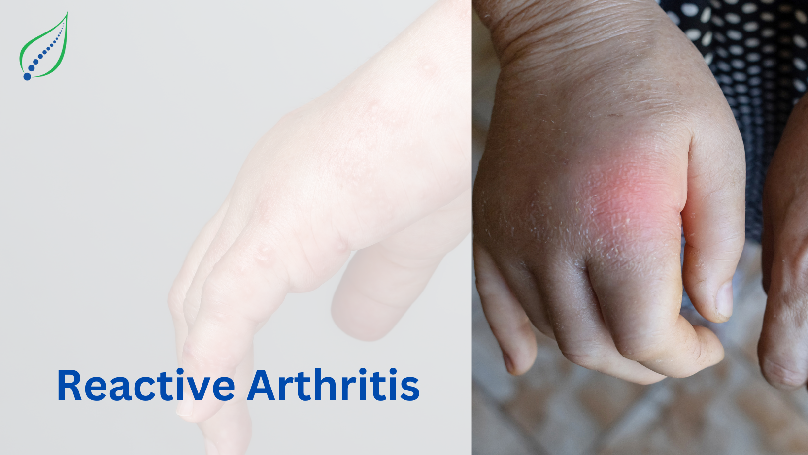 Reactive Arthritis